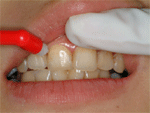 図2：歯の表面から歯垢を完全に除去します